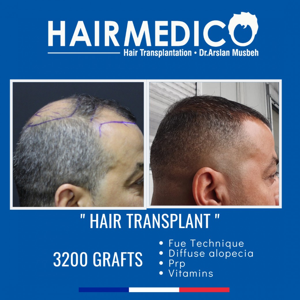 Hairmedico Dr Arslan Istanbul Turquie