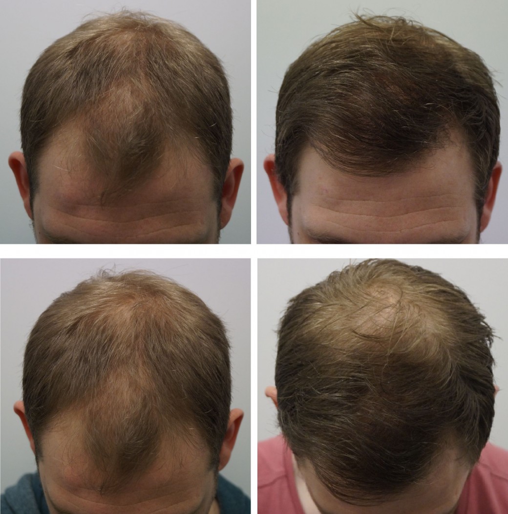 Acheter du finasteride en ligne