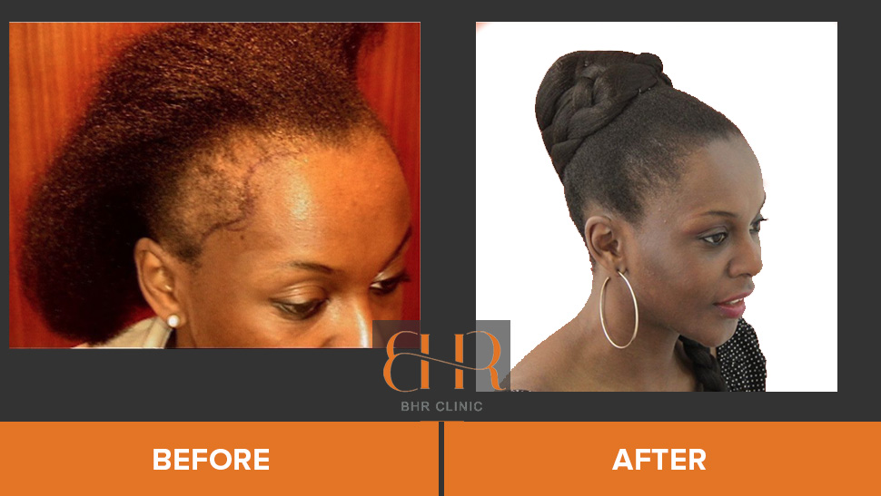FUE - Frontal restoration - Afro hair