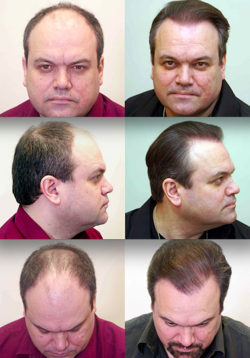 Top 25 Best Hair Transplantation Clinics Around the World  HairMighty