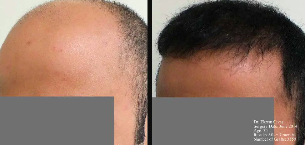 FUE - 3550 grafts - Extended baldness