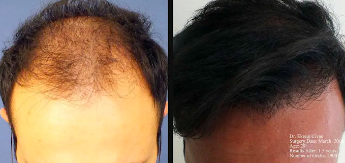 FUE - 2900 grafts - Frontal reconstruction