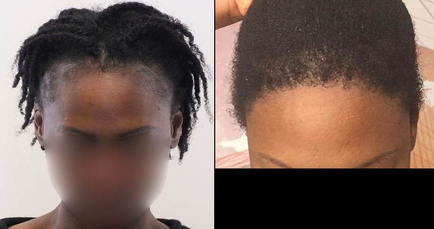 FUE - 1300 grafts - Frontal restoration on afro hair