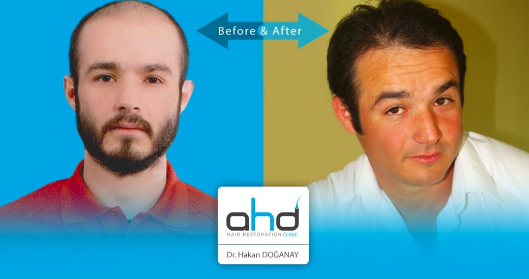 Fue 4100 Grafts Baldness