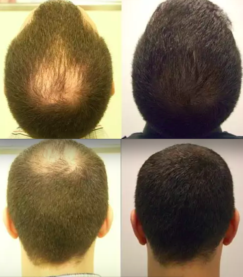 Coût du finasteride