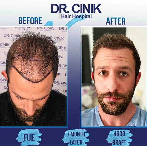 Fue 4600 Grafts Diffuse Widespread Baldness
