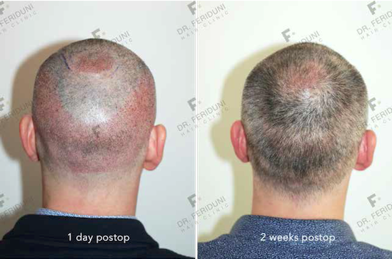FUE - 3705 grafts - frontal hairline - crown area