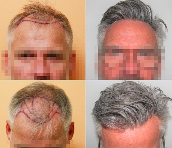 FUE - 3003 grafts - First frontal third reconstruction