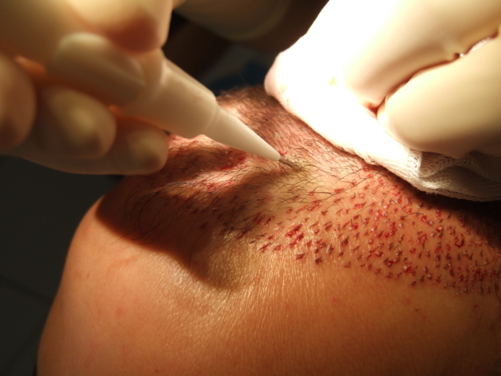 Dr Gilles Martin-Peridier, Marseille, France