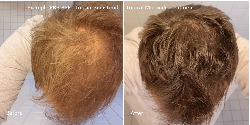 Coût du finasteride