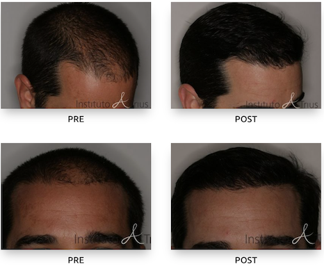 What is Diffuse Thinning Hair Loss  Best Hair Transplant