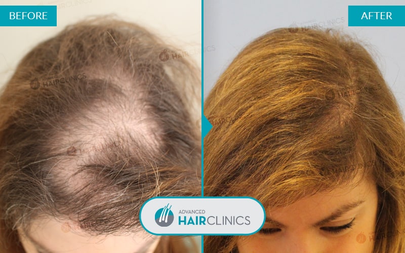 Алопеция у женщин лечение отзывы. Дарсонваль алопеция андрогенная. Мезотерапия для волос. Мезотерапия волос до и после.