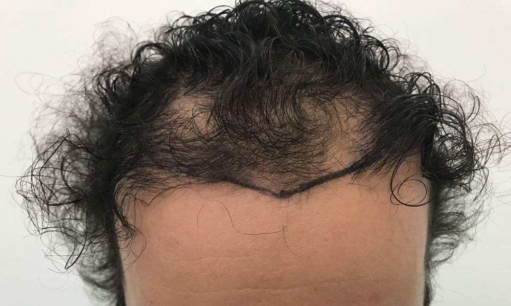 Dr. Chiara Insalaco, Rome, Italy, FUE hair transplant with no shave
