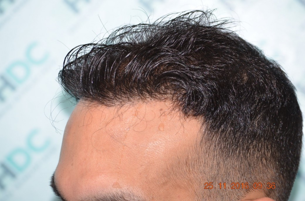 HDC Hair Transplant Clinic, Nicosia, Cyprus