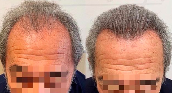 FUE - 3500 grafts - Frontal reconstruction