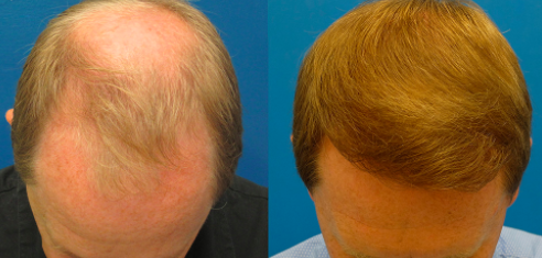Best Hair Clinics | Hair transplant experts all over Europe